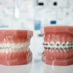 Brackets o Invisalign: cuál conviene según el caso