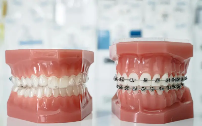 Brackets o Invisalign: cuál conviene según el caso Brackets o Invisalign: cuál conviene según el caso