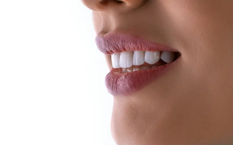 Carillas dentales en Panamá: cuándo sí y cuándo no