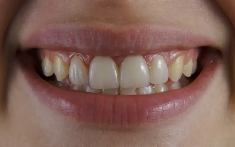 Blanqueamiento dental en Panamá: en consultorio o en casa Blanqueamiento dental en Panamá: en consultorio o en casa