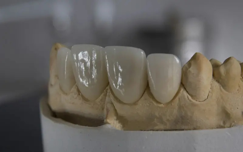 Crown or Implant: When Each Fits and What a Bridge Is Crown or Implant: When Each Fits and What a Bridge Is