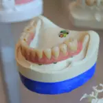 Dentures or Implants: What Changes and When an Overdenture Fits