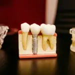 Cuánto dura un implante dental en Panamá: qué dicen los estudios