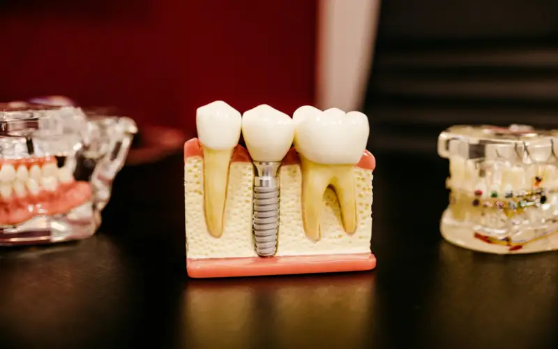 Cuánto dura un implante dental en Panamá: qué dicen los estudios Cuánto dura un implante dental en Panamá: qué dicen los estudios