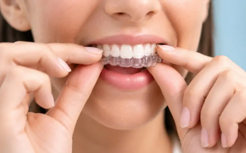 Invisalign en Panamá: cómo funciona, duración y candidatos Invisalign en Panamá: cómo funciona, duración y candidatos